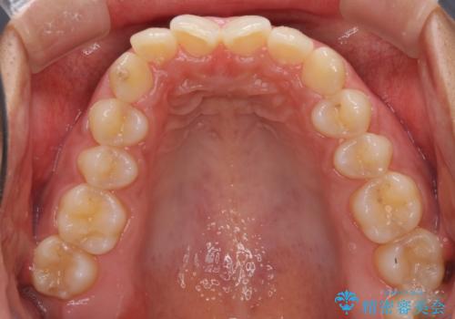 ディープバイトと前歯のデコボコを治したい インビザラインによる矯正治療の治療前