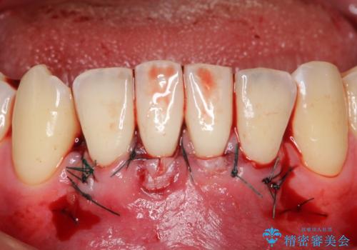 下顎前歯の歯肉退縮　結合組織を用いた根面被覆の治療中