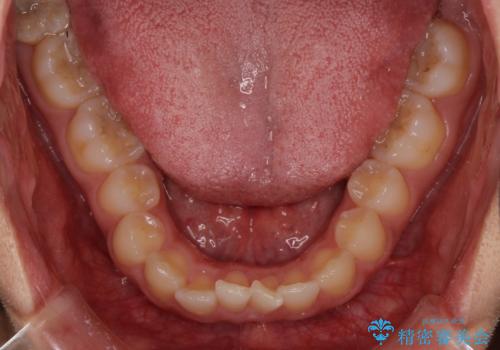 ディープバイトと前歯のデコボコを治したい インビザラインによる矯正治療の治療前