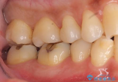 奥歯の虫歯 セラミックインレーにの治療後