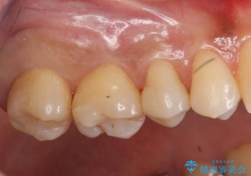 奥歯の虫歯 セラミックインレーにの治療後