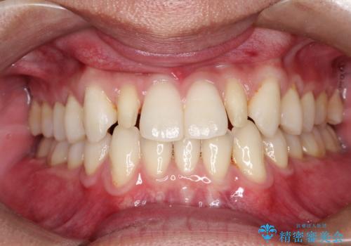矮小歯(通常より小さな歯)をオールセラミックを装着して自然な歯への治療中