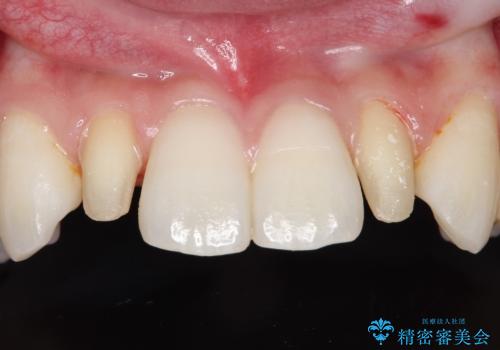 矮小歯(通常より小さな歯)をオールセラミックを装着して自然な歯への治療中