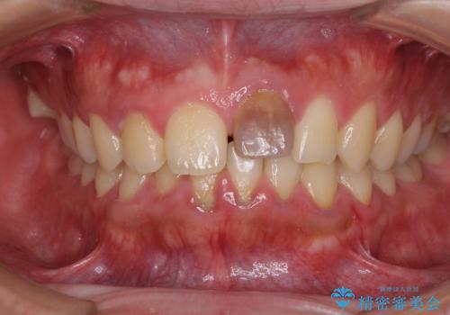 ぶつけた前歯 変色歯をオールセラミッククラウンにの治療前