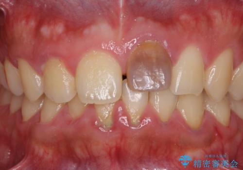 ぶつけた前歯 変色歯をオールセラミッククラウンにの治療前