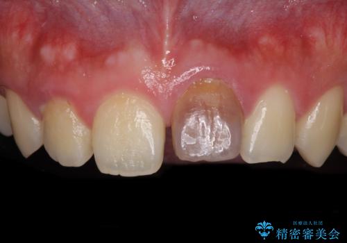 ぶつけた前歯 変色歯をオールセラミッククラウンにの症例 治療前