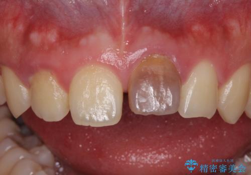 ぶつけた前歯 変色歯をオールセラミッククラウンにの治療前