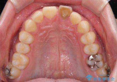 ぶつけた前歯 変色歯をオールセラミッククラウンにの治療前