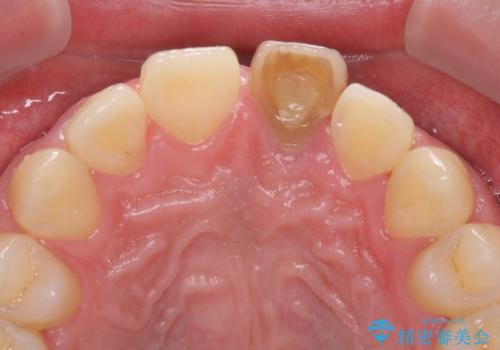 ぶつけた前歯 変色歯をオールセラミッククラウンにの治療前