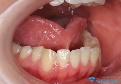 舌が持ち上がらない　舌小帯切除の治療前