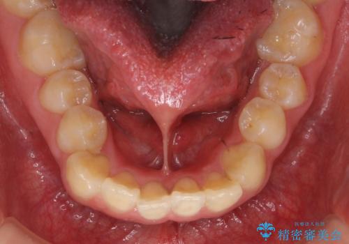 舌が持ち上がらない 舌小帯切除の治療前