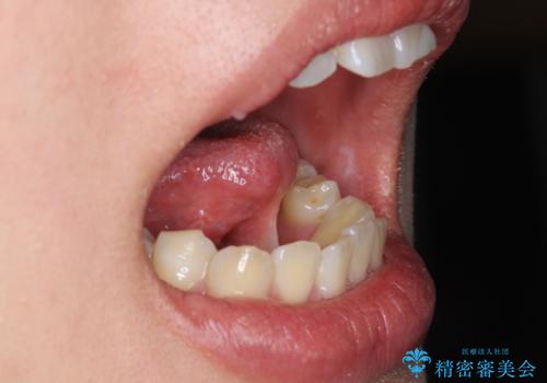 舌が持ち上がらない 舌小帯切除の治療前