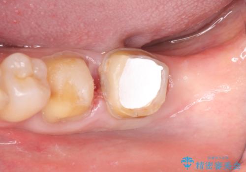 オールセラミッククラウン　歯茎より深い虫歯の治療　神経が死んでる歯の治療の治療前