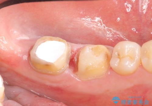 オールセラミッククラウン 歯茎より深い虫歯の治療 神経が死んでる歯の治療の治療前