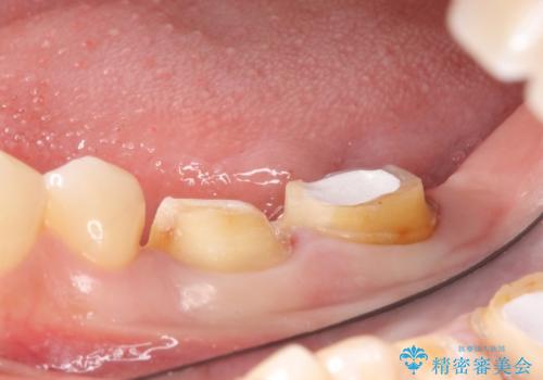 オールセラミッククラウン 歯茎より深い虫歯の治療 神経が死んでる歯の治療の治療前