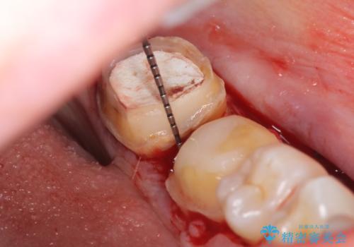 オールセラミッククラウン　歯茎より深い虫歯の治療　神経が死んでる歯の治療の治療中