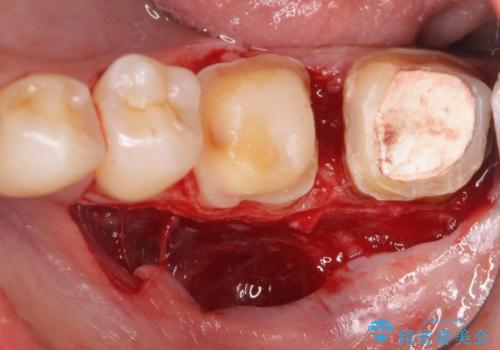 オールセラミッククラウン 歯茎より深い虫歯の治療 神経が死んでる歯の治療の治療中