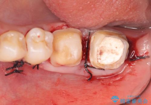 オールセラミッククラウン 歯茎より深い虫歯の治療 神経が死んでる歯の治療の治療後