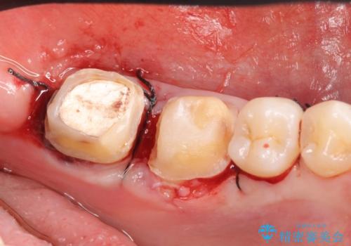 オールセラミッククラウン 歯茎より深い虫歯の治療 神経が死んでる歯の治療の治療後