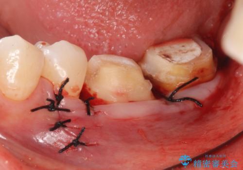 オールセラミッククラウン 歯茎より深い虫歯の治療 神経が死んでる歯の治療の治療後