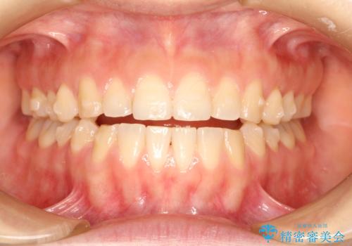 上下の前歯が当たらない　インビザラインによる開咬の矯正治療の治療中
