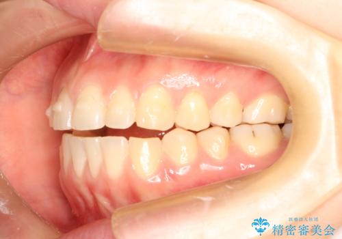 上下の前歯が当たらない インビザラインによる開咬の矯正治療の治療中