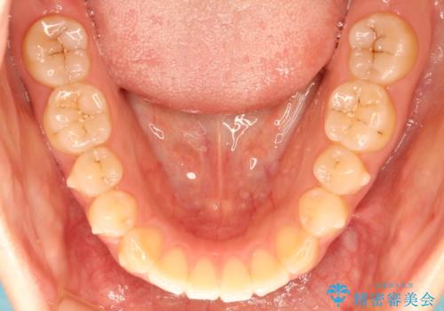 上下の前歯が当たらない　インビザラインによる開咬の矯正治療の治療中