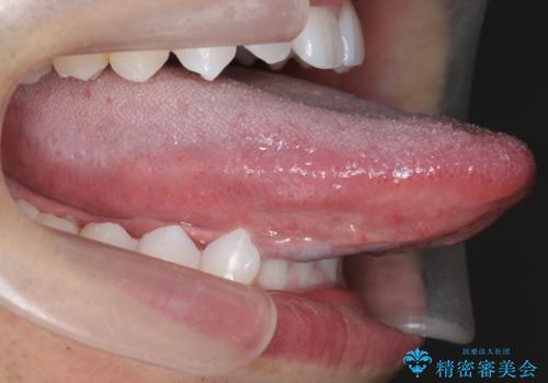 舌小帯を切りたい 発音を良くしたいの治療後