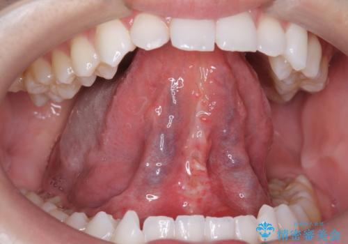 舌小帯を切りたい 発音を良くしたいの治療後