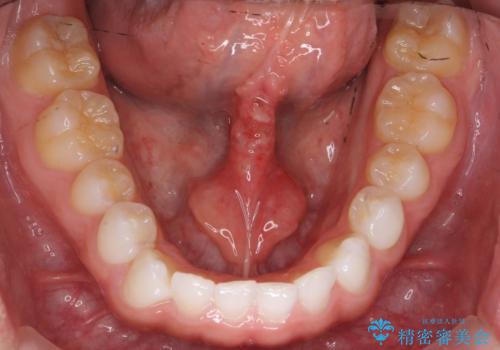 舌小帯を切りたい 発音を良くしたいの治療後