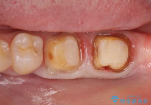 オールセラミッククラウン 歯茎より深い虫歯の治療 神経が死んでる歯の治療の治療中