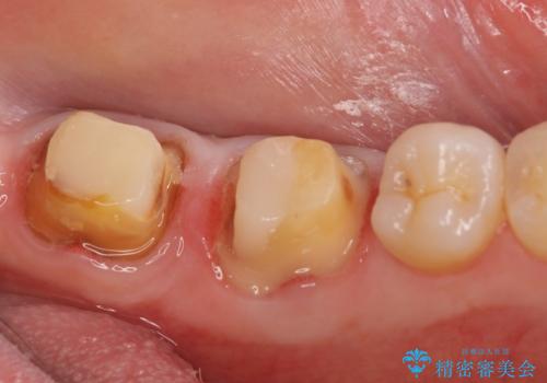 オールセラミッククラウン 歯茎より深い虫歯の治療 神経が死んでる歯の治療の治療中