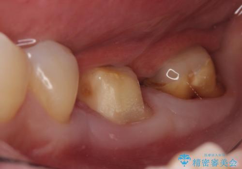 オールセラミッククラウン　歯茎より深い虫歯の治療　神経が死んでる歯の治療の治療中