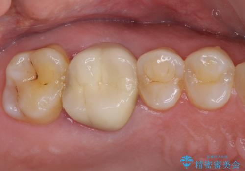 歯周外科処置を併用した奥歯の補綴治療の症例 治療前