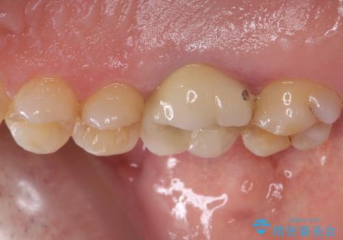 歯周外科処置を併用した奥歯の補綴治療の治療前