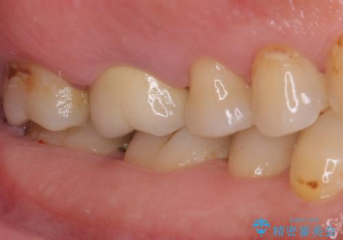 歯周外科処置を併用した奥歯の補綴治療の治療前