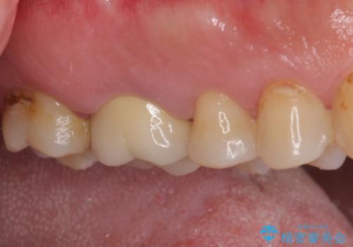 歯周外科処置を併用した奥歯の補綴治療の治療前