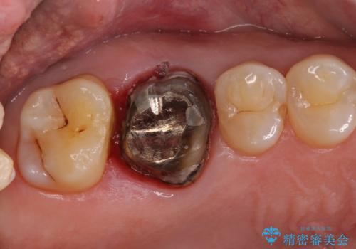 歯周外科処置を併用した奥歯の補綴治療の治療中