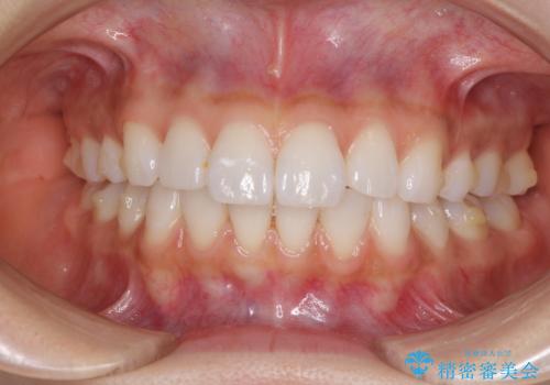 矯正治療の後戻り インビザラインによる再矯正治療の治療中