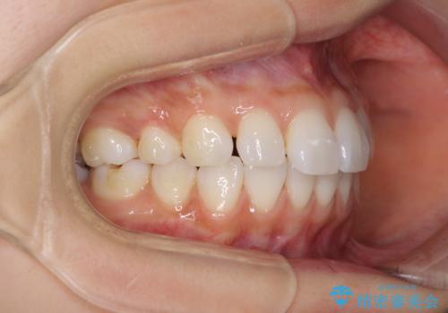 矯正治療の後戻り インビザラインによる再矯正治療の治療中