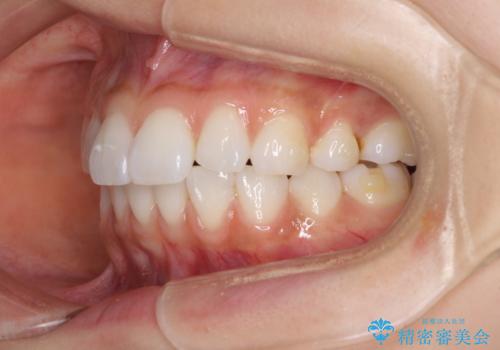 矯正治療の後戻り インビザラインによる再矯正治療の治療中