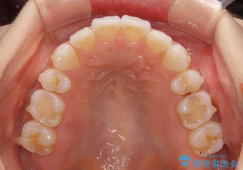 矯正治療の後戻り インビザラインによる再矯正治療の治療中
