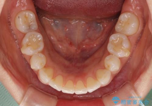 矯正治療の後戻り インビザラインによる再矯正治療の治療中