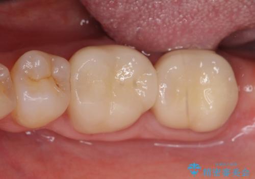 オールセラミッククラウン　歯茎より深い虫歯の治療　神経が死んでる歯の治療の症例 治療後