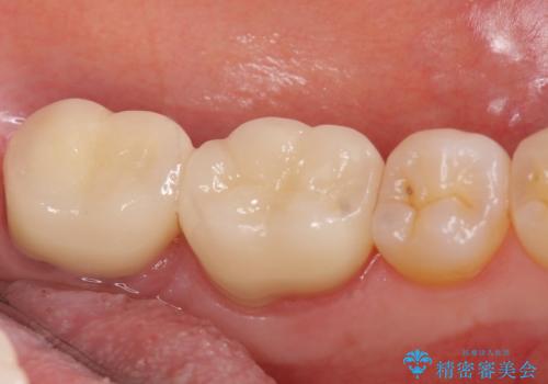 オールセラミッククラウン　歯茎より深い虫歯の治療　神経が死んでる歯の治療の治療後