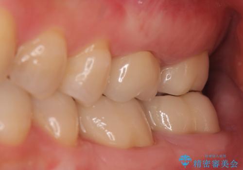 オールセラミッククラウン 歯茎より深い虫歯の治療 神経が死んでる歯の治療の治療後