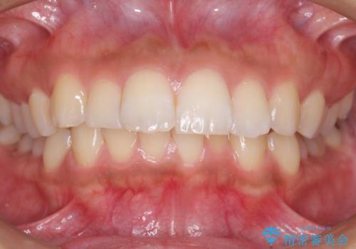 Eラインを整える治療 前歯を引っ込めますの治療前