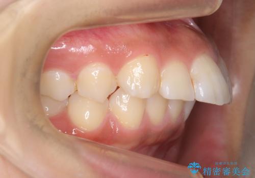 Eラインを整える治療 前歯を引っ込めます