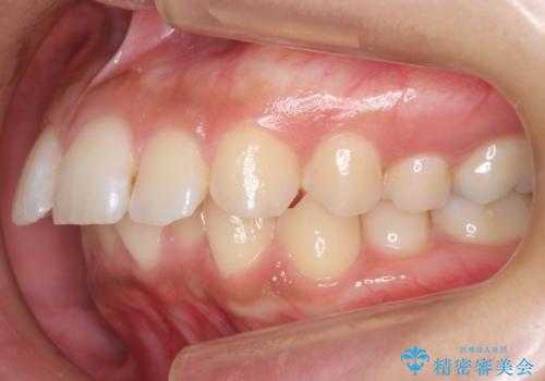 Eラインを整える治療 前歯を引っ込めますの治療前