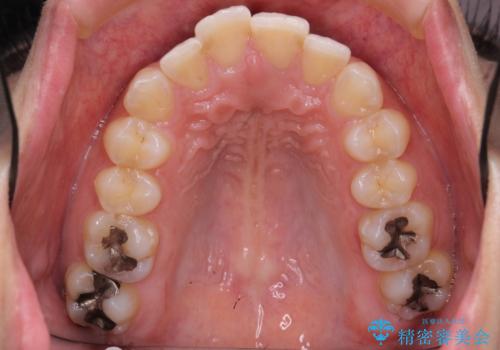 Eラインを整える治療 前歯を引っ込めますの治療前